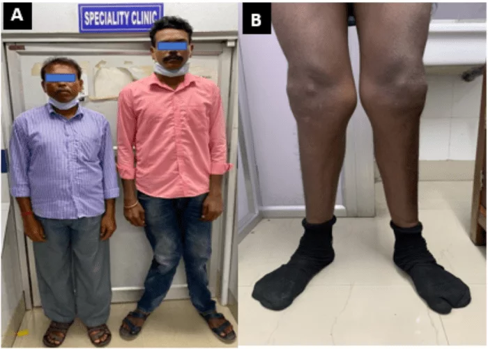 The patient height compared to his father showing tall stature and knock knees A