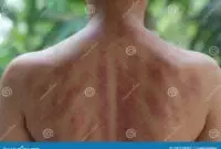 gua sha chinese also called scraping spooning coining kerokan indonesia traditional medicine back young woman 241578957